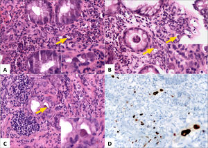 Paciente con colitis y enteritis por Citomegalovirus (CMV).