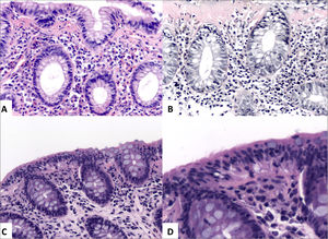 Colitis Microscópica.