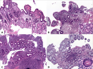 Alteraciones distintivas de colitis crónica.