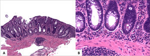 Plasmocitosis basal.