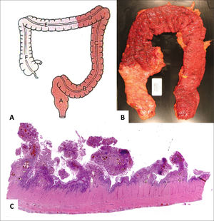 Pieza quirúrgica correspondiente a segmento de intestino grueso con CUI.