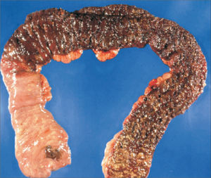Parche cecal Colectomía total con área de inflamación eritematosa en el ciego rodeada de colon normal asociada a colitis de segmentos distales del colon (tomada de Gramlich y cols1).