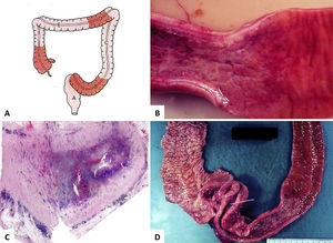 Características macroscópicas de la enfermedad de Crohn.