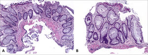 Colitis ulcerativa idiopática en remisión A (sigmoides, HE 40x) y B (recto, HE 100x) corresponde a colitis crónica inactiva caracterizada por distorsión arquitectural dada por acortamiento y ramificación de criptas, metaplasia de células de Paneth y ausencia de actividad inflamatoria. Nótese la ausencia de plasmocitosis basal en B. Tomada de Chiu y cols.24.