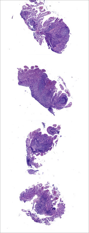 Enfermedad de Crohn Fragmentos de mucosa íleal con grados variables y parcelares de inflamación en la lámina propia en y entre los fragmentos.