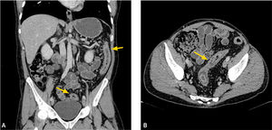Colitis ulcerosa. Reformateo coronal (a) y corte axial (b) de ETC, que evidencia engrosamiento parietal estratificado de colon descendente y sigmoides (flechas).