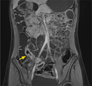 Enfermedad de Crohn de íleon, subtipo inflamatorio. Corte coronal de ERM secuencia T1 con saturación grasa post contraste, que evidencia engrosamiento parietal estratificado de íleon distal (flecha) asociado a proliferación de la vasa recta (signo de la peineta).