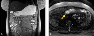 Enfermedad de Crohn de yeyuno, subtipo inflamatorio. Indice de actividad MaRIA severo. Secuencia T2 coronal (a) que muestra engrosamiento multisegmentario de yeyuno con edema de la submucosa, lo que le da un puntaje de 5. Secuencia de difusión axial (b) que evidencia restricción similar en pared de intestino y en ganglios mesentéricos (flechas), lo que le da un puntaje de 10.