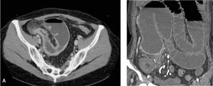 Enfermedad de Crohn de íleon, subtipo fibroestenosante. Corte axial (a) y reformateo coronal (b) de ETC de dos pacientes diferentes, que muestran dilatación de asas de intestino delgado, con cambio de calibre en relación a un engrosamiento no estratificado de la pared del íleon.