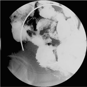 Enfermedad de Crohn ileocólica, subtipo fistulizante. Tránsito de intestino delgado, que muestra múltiples trayectos fistulosos enteroentéricos y enterocólicos asociado a engrosamiento parietal y disminución de calibre del íleon distal.