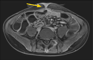 Enfermedad de Crohn de íleon, subtipo fistulizante. Secuencia axial T1 con saturación grasa postcontraste, que muestra un trayecto fistuloso enterocutáneo caudal al ombligo, que refuerza con contraste (flecha).