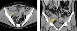 Enfermedad de Crohn de íleon, subtipo fistulizante. Corte axial (a) y reformateo coronal (b) de paciente con engrosamiento parietal de íleon, fístulas enteroentéricas, enterocólicas y masa inflamatoria mesentérica con absceso central.