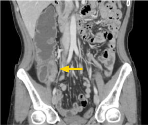 Ileocolitis por Salmonella. Paciente hombre de 20 años, con fiebre y dolor abdominal. Reformateo coronal de TC de abdomen muestra ileitis distal y linfonodos ileocólicos prominentes.