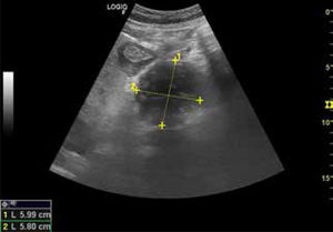 Ecografía abdominal clínica Se evidencia lesión en glándula pancreática de 5.99cm x 5.80cm.