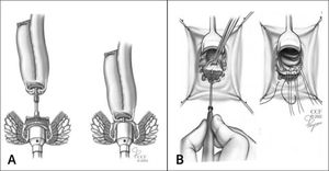Técnicas de anastomosis ileoanal.