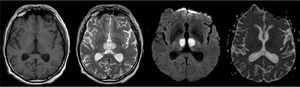 RM de cerebro. Secuencias T1, T2, Difusión y ADC, caso 1 Se observa aumento de la señal en T2 a nivel del tálamo paramedial en forma bilateral, asociado a brillo en las secuencias de difusión y caída en ADC.