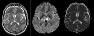 RM de cerebro. Secuencias T2, Difusión y ADC, caso 2.