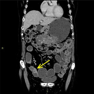 Computed Tomography Enterography (CTE) of a patient with terminal ileal Crohn