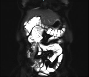 Magnetic Ressonanse Enterography (MRE) of a patient with terminal proximal small bowel Crohn