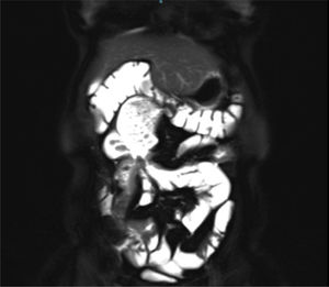 Magnetic Ressonanse Enterography (MRE) of a patient with terminal proximal small bowel Crohn's disease with internal fistula and small bowel proximal dilatation.