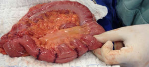 Heineke-Mikulicz technique for multiple short stenosis in the terminal ileum of a CD patient.