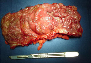 Specimen of a segmental colectomy in a CD patient with a single segment of the colon involved by the disease.