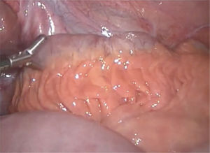 Laparoscopic inspection of a terminal ileum with fat wrapping and associated stenosis in a CD patient.