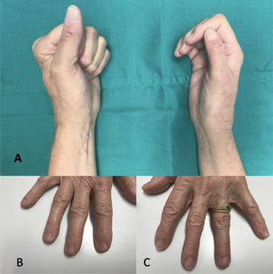Clínica del SDRC. A. Manos de una paciente afectada por SDRC en mano derecha. Se puede observar la falta de cierre completo del puño. B. Edema de dedos, piel brillante y disminución de pliegues cutáneos en dedos. C. Mano sana. Las fotografías e imágenes han sido tomadas con el consentimiento de los pacientes.