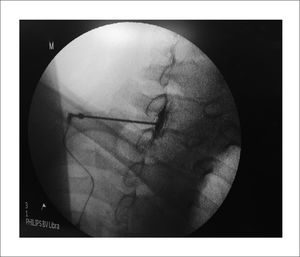 Catéter epidural cervical. Inyección a nivel de C7 y distribución del contraste hasta T1.