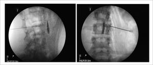 Bloqueo neurolítico o simpatectomía lumbar. Imagen fluoroscópica lateral y anteroposterior de simpatectomía lumbar a nivel de L3.