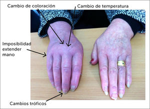 Exploración y diagnóstico de SDRC. Nótese los cambios de coloración, los cambios en la temperatura se explotan, comparando una extremidad con la otra; cambios tróficos a nivel ungueal y la imposibilidad de extender la mano.