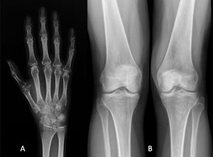 Radiografía de paciente con SDRC. A. Osteopenia difusa en huesos de la mano. B. Rodilla izquierda con osteopenia difusa periarticular.