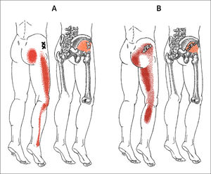 Patrón de dolor referido por los puntos gatillo A) Patrón de dolor referido por los puntos gatillo (x) de la parte anterior del músculo glúteo menor derecho (rojo claro). El patrón esencial de dolor aparece en rojo sólido y la extensión de desbordamiento que se observa cuando el músculo está más severamente afectado aparece en rojo punteado. (de Travell JG, Simons DG. Dolor y disfunción miofascial. El manual de los puntos gatillo. Vol. 2. Extremidades inferiores. 1a edición. Médica Panamericana, - 2004, p. 210.). B) Patrón de dolor compuesto (rojo fuerte) referido por los puntos gatillo (x) de la parte posterior del músculo glúteo menor derecho (rojo claro). El patrón de dolor esencial aparece en rojo sólido y el patrón de desbordamiento aparece punteado. (de Travell JG, Simons DG. Dolor y disfunción miofascial. El manual de los puntos gatillo. Vol. 2. Extremidades inferiores. 1a edición. Médica Panamericana, - 2004, p. 210.).