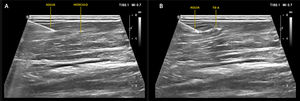 Ecografía de apoyo al procedimiento de infiltración muscular con TB-A A) Se muestra la trayectoria de la aguja en el músculo recto femoral. (Imagen de procedimiento de las autoras, con el apoyo ecográfico de Servicio de radiología Clínica Las Condes). B) Se muestra la trayectoria de la aguja y la inyección de TB-A en el músculo recto femoral. (Imagen de procedimiento de las autoras, con el apoyo ecográfico de Servicio de radiología Clínica Las Condes).