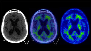 PET/CT amiloide Pacientes de 73 años con deterioro cognitivo leve, sin criterios clínicos de demencia. Presenta leve acumulación anormal de F18-Florbetaben en corteza temporal izquierda y parietal derecha.