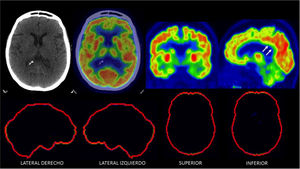 PET/CT F18-FDG normal en un paciente de 70 años con trastorno de memoria Se observa captación alta homogénea en corteza cerebral, lo que indica actividad sináptica normal. Nótese captación simétrica entre ambos hemisferios cerebrales y la alta captación del cíngulo posterior (flechas). En las imágenes inferiores se muestra software de comparación con base de datos de cerebros normales de la misma edad y sexo (Cortex ID ®) sin alteraciones.