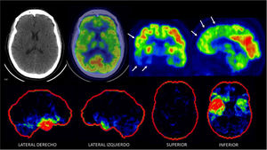 PET/CT F18-FDG en paciente de 68 años con demencia frontotemporal Captación irregularmente disminuida en corteza temporal y frontal, especialmente a derecha (flechas). El cíngulo posterior se aprecia de metabolismo glucídico conservado. En las imágenes inferiores se muestra software Cortex ID ® con severa alteración temporal y frontal asimétrica (en rojo lo más alterado y en verde lo menos).