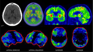 PET/CT F18-FDG en paciente de 71 años con enfermedad de Alzheimer Típico patrón de hipocaptación de F18-FDG biparietotemporal, que puede ser asimétrica como en este paciente que es más acentuada a izquierda, con compromiso del cíngulo posterior (flechas). Hay respeto relativo de la banda motora a ambos lados. En algunos casos puede existir alteración de la corteza frontal, como en este paciente. En las imágenes inferiores las alteraciones descritas son significativas respecto a la comparación con base de datos (captación -2DS bajo lo esperado para la edad y sexo).