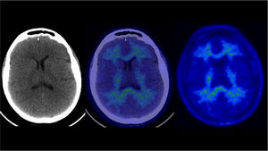 PET/CT amiloide. Paciente de 65 años con trastorno de memoria, con estudio F18-Florbetaben norma No hay acumulación de radiotrazador en corteza cerebral. La captación en sustancia blanca no es necesariamente patológica, y puede ir aumentando con la edad en población normal.