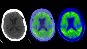 PET/CT amiloide Paciente de 68 años con EA que presenta acentuada acumulación de F18-Florbetaben en corteza cerebral, patrón característico de esta enfermedad.