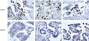 Tejido del plexo coroideo humano (PCH) con infiltración leucocítica La tinción revela clusters de células +CD45 [cluster de diferenciación +45] con las características morfológicas de linfocitos en el estroma del PCH de pacientes con LES, pero no en los controles. (Modificado de Stoke, JCIInsight. 2019).