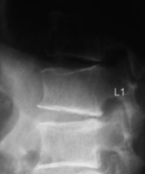 Fractura vertebral osteoporótica de L1.