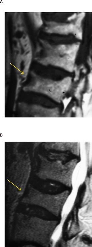 A: Fractura vertebral antigua de L1 y L2. B: Se evidencia la falta de edema en la secuencia T2.