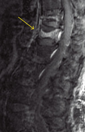 Fractura vertebral con aumento de señal en secuencia STIR, a causa del edema en una fractura aguda.