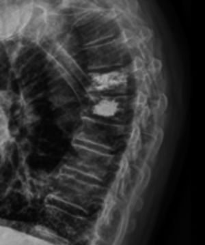 Vertebroplastia percutánea.