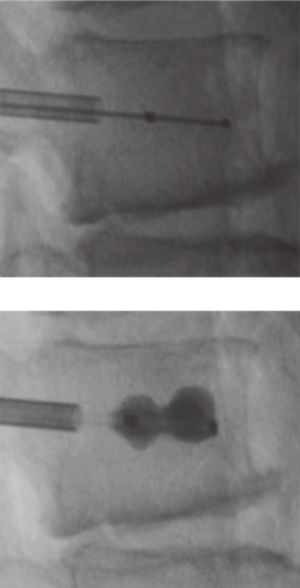 Cifoplastia percutánea con balón.