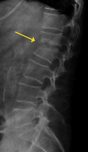 Radiografía Simple Columna Vertebral. Radiografía que muestra disminución de la altura discal, pérdida de definición de las placas vertebrales, lesiones líticas en plataformas vertebrales, y colapso vertebral en espondilodiscitis L1-L2.