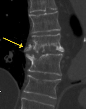 Reconstrucción coronal de tomografía computada que muestra pérdida de definición de placas vertebrales y lesiones líticas en paciente con espondilodiscitis.