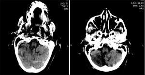 TC de cerebro de ingreso y TC de cerebro control a los 40 minutos posteriores al inicio de infusión de rTPA.