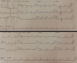 Electrocardiograma de ingreso y electrocardiograma control (40 minutos).